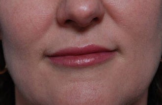 Woman seeking permanent lip augmentation after 1287685