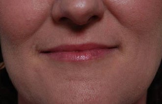 Woman seeking permanent lip augmentation before 1287685