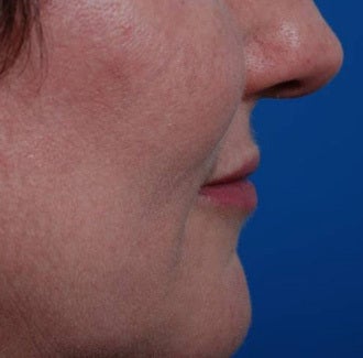 Woman seeking permanent lip augmentation 1287685