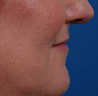Woman seeking permanent lip augmentation 1287685