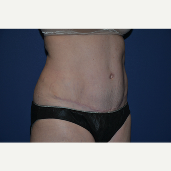 35-44 year old mother of twins treated with Tummy Tuck after 3004915