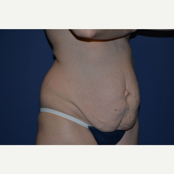 35-44 year old mother of twins treated with Tummy Tuck before 3004915