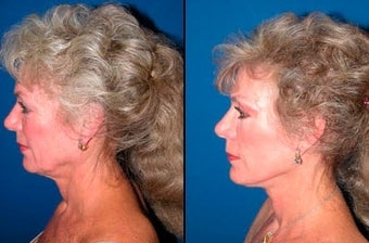 61 year old woman treated with Facelift before 3004825