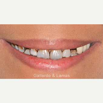 45-54 year old woman treated with All-on-4 Dental Implants before 3075158
