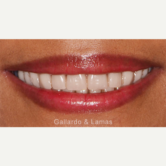 45-54 year old woman treated with All-on-4 Dental Implants after 3075158