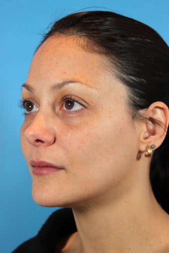 Botox and Fillers (Restylane and Juvederm) 936970