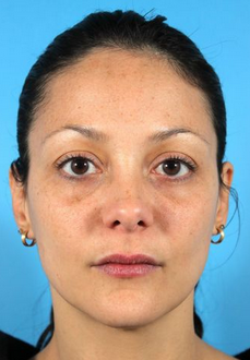 Botox and Fillers (Restylane and Juvederm) before 936970