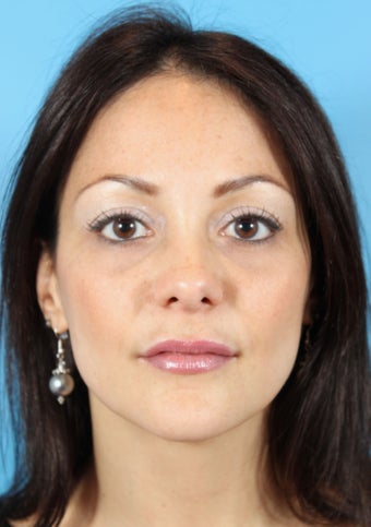 Botox and Fillers (Restylane and Juvederm) after 936970