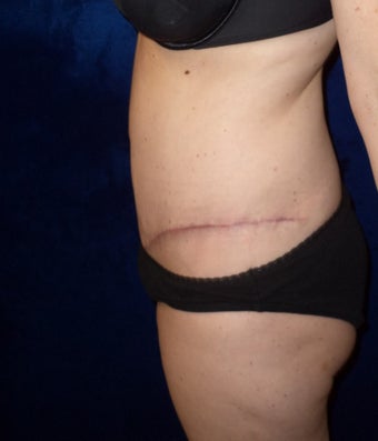 45yo Female treated for severe abdominal wall laxity and stretch marks post-partum 1456342