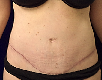 45yo Female treated for severe abdominal wall laxity and stretch marks post-partum after 1456342