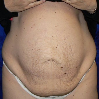 45yo Female treated for severe abdominal wall laxity and stretch marks post-partum before 1456342