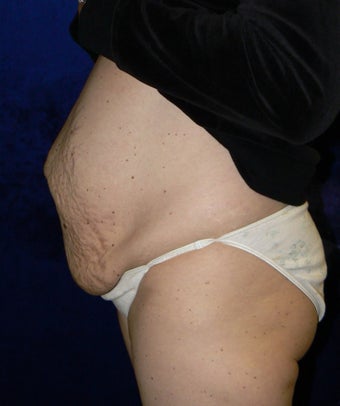 45yo Female treated for severe abdominal wall laxity and stretch marks post-partum 1456342