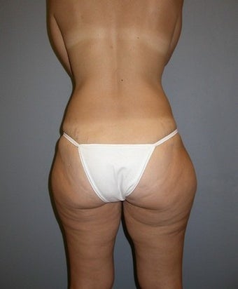35 Year Old Liposuction Patient before 1358916
