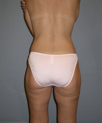35 Year Old Liposuction Patient after 1358916