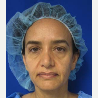 Eyelid Surgery before 3164343