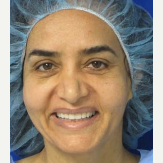 Eyelid Surgery after 3164343