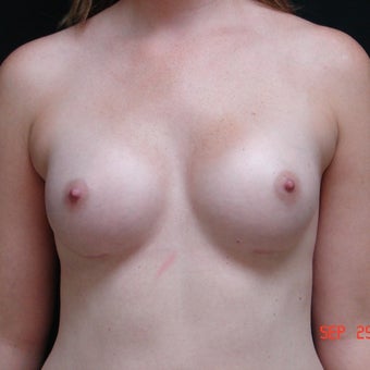 Conservative Breast Augmentation after 1913326
