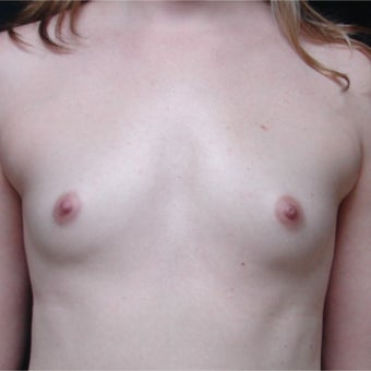 Conservative Breast Augmentation before 1913326