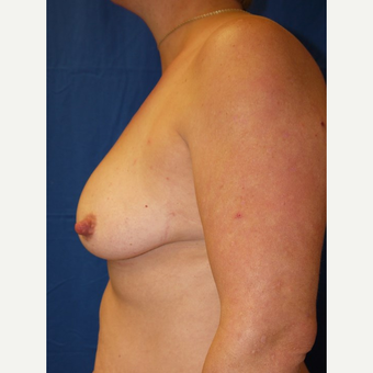 Breast Augmentation before 3744225