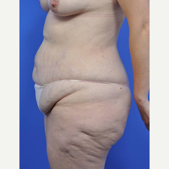 45-54 year old woman treated with Body Lift before 3450485