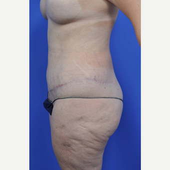 45-54 year old woman treated with Body Lift after 3450485