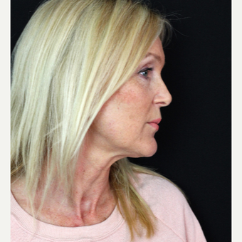 45-54 year old woman treated with Facelift before 3498638