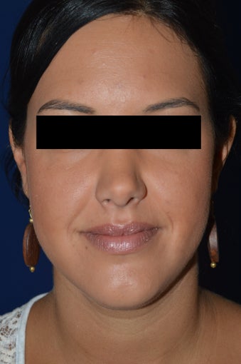 36 Year Old Female Treated for Heaviness in the Neck 1024353