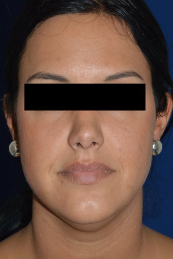 36 Year Old Female Treated for Heaviness in the Neck 1024353