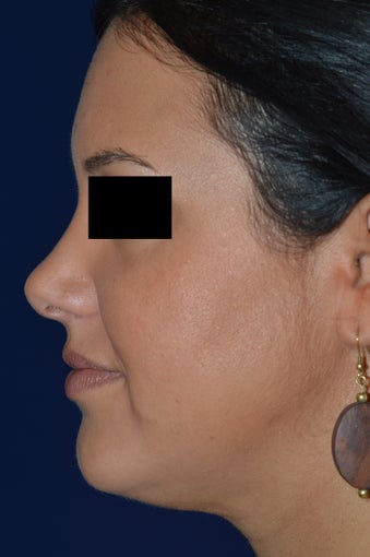 36 Year Old Female Treated for Heaviness in the Neck after 1024353