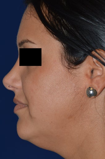 36 Year Old Female Treated for Heaviness in the Neck before 1024353