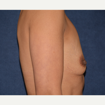 45-54 year old woman treated with Breast Implants before 3454897