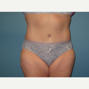 45-54 year old woman treated with Tummy Tuck after 1861463
