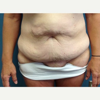 45-54 year old woman treated with Tummy Tuck before 1861463