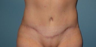 45-54 year old woman treated with Tummy Tuck 1861463