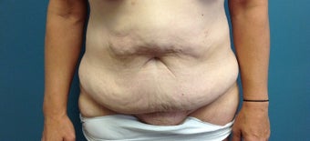 45-54 year old woman treated with Tummy Tuck 1861463
