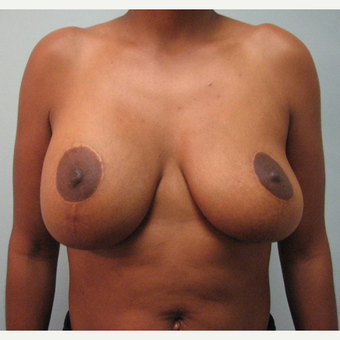 Breast Implant Removal combined with a breast lift in 43 year old patient before 3780950