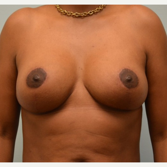 Breast Implant Removal combined with a breast lift in 43 year old patient after 3780950