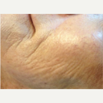 25-34 year old woman treated with Microneedling before 2833817