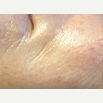 25-34 year old woman treated with Microneedling after 2833817