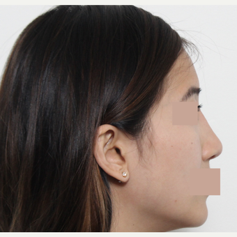 25-34 year old woman treated with Rhinoplasty after 3366488