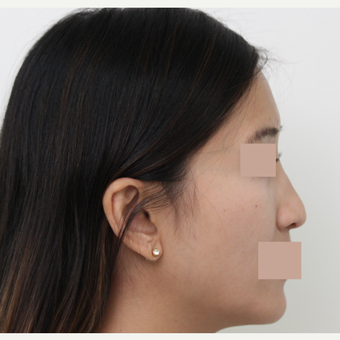 25-34 year old woman treated with Rhinoplasty before 3366488