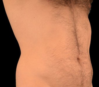 25-34 year old man treated with Liposculpture before 1602649