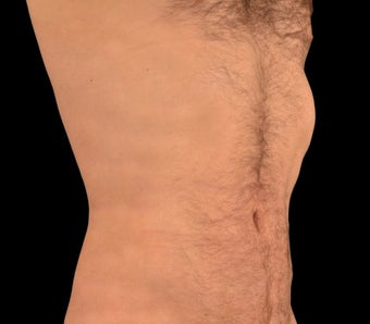 25-34 year old man treated with Liposculpture after 1602649