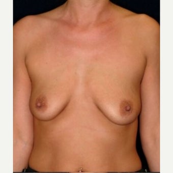 Benelli Mastopexy with Implants in a 36-year-old; Benelli Augmentation Mastopexy before 1551023