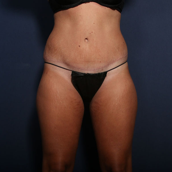 25-34 year old woman treated with Tummy Tuck (view 1 of 2) after 3372163