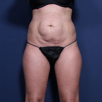 25-34 year old woman treated with Tummy Tuck (view 1 of 2) before 3372163