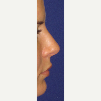 Non Surgical Nose Job after 3084730