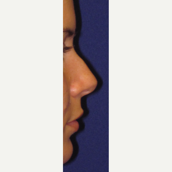 Non Surgical Nose Job before 3084730