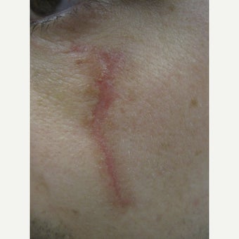 18-24 year old man treated with Scars Treatment before 2114788