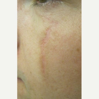 18-24 year old man treated with Scars Treatment after 2114788